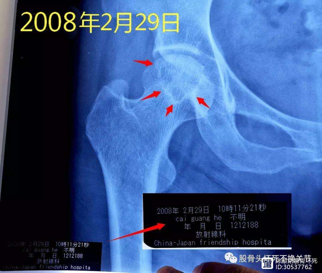 宝鸡人工骨头医保报销多少(人工骨头医保报销多少比例)