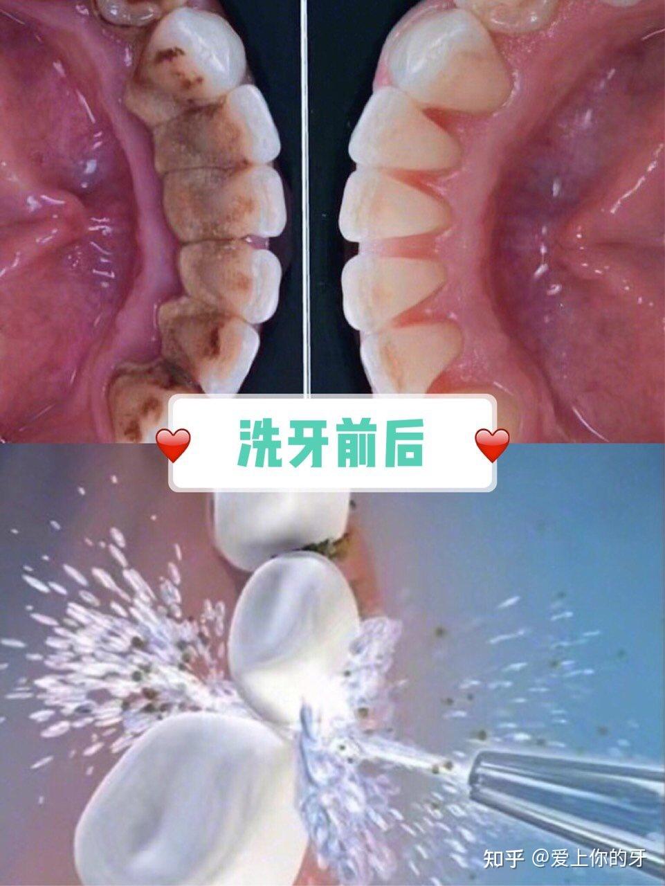 宝鸡洗牙可以用医保吗(洗牙可以用医保吗,报销比例多少)